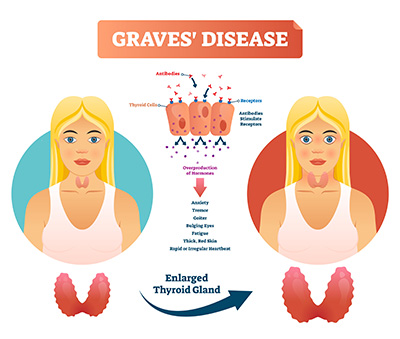 Graves' Disease Specialist Palo Alto CA